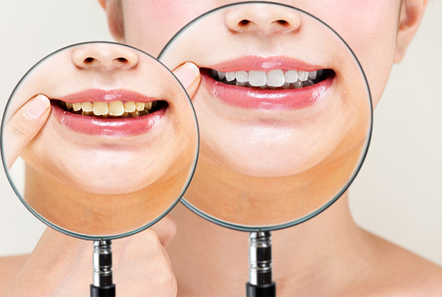 ホワイトニング